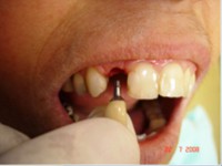 /album/galeria-de-fotos-carga-imediata-apos-exodontia-atraumatica-/carga-imediata-com-exodontia-atraumatica20-jpg/